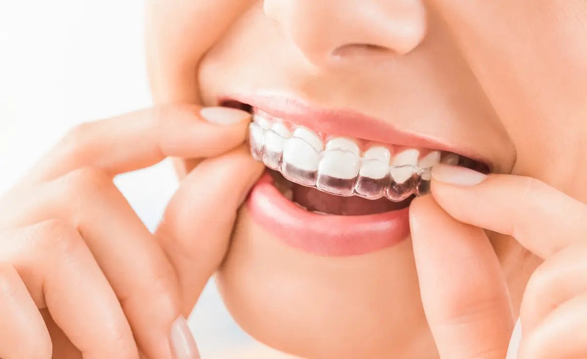 Aligner für die unsichtbare Zahnkorrektur bei Erwachsenen