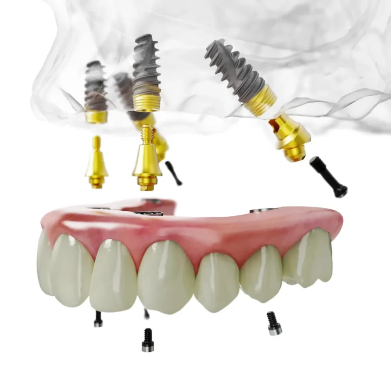 Feste Zähne auf Implantaten