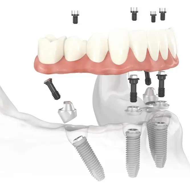 All-on-4®-Behandlungskonzept: Zahnbrücke auf vier Implantaten
