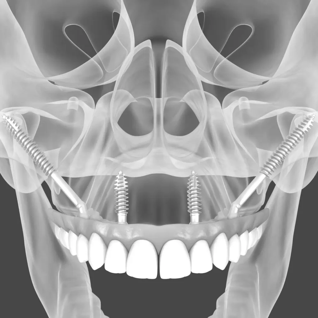 Röntgenartige Darstellung von Zygoma-Implantaten im Oberkiefer