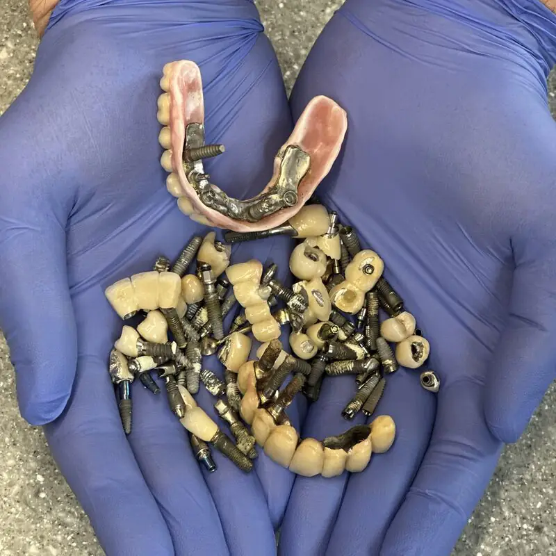 Implantatverlust - Verlorene Zahnimplantate in der Hand des Zahnarztes
