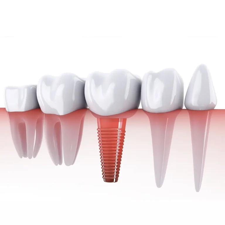 3D-Darstellung einer Zahnreihe mit Implantat als Ersatz für einen fehlenden Zahn