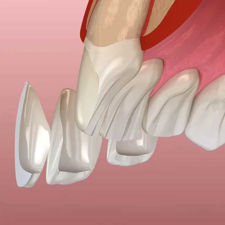3D-Darstellung von Veneers, die auf die Frontzähne gesetzt werden