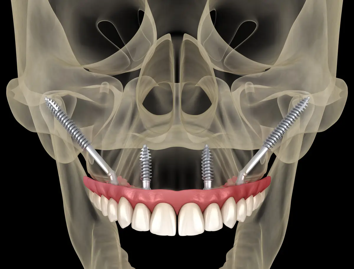 Zygoma Zahnimplantate